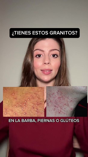 Entiende la foliculitis: Causas y Tratamientos Efectivos