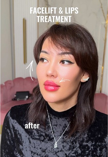 ✨ Complex treatment: facelift & lips augmentation Before or After? 📍Moscow | Dubai | London appointments Schedule an appointment with one of our talented aesthetic doctors 👉 Sign up now: www.LFK-academy.com #recommendations #cosmetology #skincare #fyp #fashion #estetik #lipfiller #jawline #fullface #botox #lifting #beauty#увеличениегуб #увеличениегубмосква #fullface #fullfaceмосква #fullfaceuk #lipfillersessex #lipaugumentation #коррекцияскул #lipfilleruk #коррекцияугловмосква #коррекцияскулмо