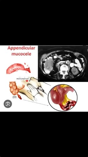 Radiology @all abnormalities 🥏🥏 on Instagram: "Ultrasound Abdomen & Pelvis Report Clinical Presentation Status post bilateral salpingo-oophorectomy, presenting with vague right lower abdominal pain. Patient Details Age: 40 years Gender: Female Ultrasound Findings Right Lower Abdomen: An elongated tubular cystic structure is seen in the right lower abdomen measuring approximately 7.7 cm in length. The lesion shows mild internal echogenicity. No obvious calcification is identified within the les