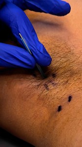 🏆 Dry needling uses a monofilament needle to target myofascial trigger points and reduce neuromuscular dysfunction. It helps restore normal muscle tone, decrease pain, and improve range of motion. 🏌🏽‍♀️🏋🏾‍♂️🏃🏻‍♂️#DryNeedling #TriggerPointTherapy #ChicagoChiropractor | Dr_kyleross