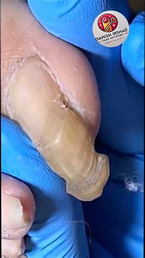15K views · 107 reactions | Effective Toenail Support for Overgrown Toenails Without Harsh Chemicals #HealthyHabits #EverydayCare #FootCareTips #NailCareTips | Danish irshad fans | Facebook
