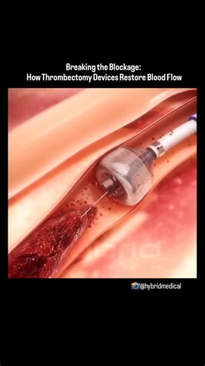 World of Biology on Instagram: "Advanced thrombectomy system designed for non-surgical removal of thrombi and emboli. This visual journey highlights how the device functions on the surface of a beating heart clearing blocked vessels and restoring life-saving blood flow. . Video credit 📸- @hybridmedical ❤️ #heart #thrombectomy"