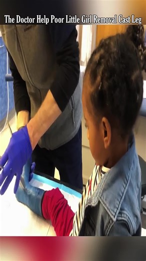 The Doctor Help Poor Little Girl Removal Cast Leg 😱 #castremoval #cutting #help #removal #brokenleg