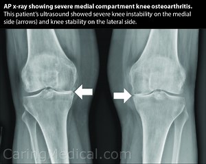 When stem cell therapy may work and may not work for your knee pain