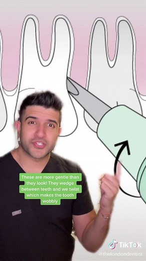 Understanding Tooth Extraction Process at the Dentist