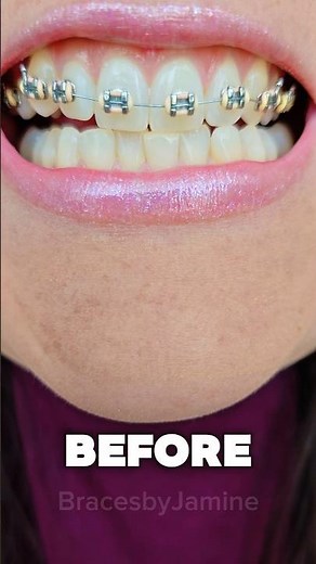 1 month of braces #transformation
