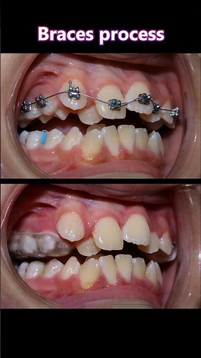Full braces process. 28 months journey #braces #orthodontist #dentist #teeth #dental