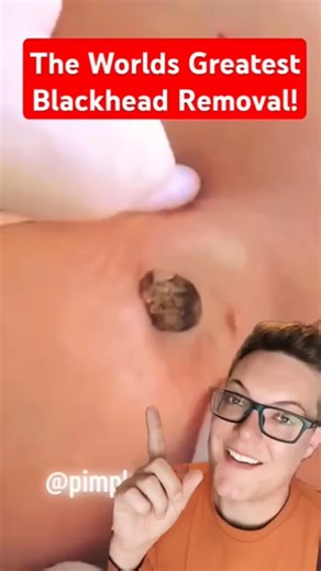 All-Time GREATEST BLACKHEAD REMOVAL - This One Had Me Shocked #shorts