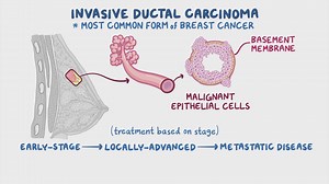 Video: Invasive ductal carcinoma: Clinical sciences - Video Explanation! | Osmosis | Osmosis