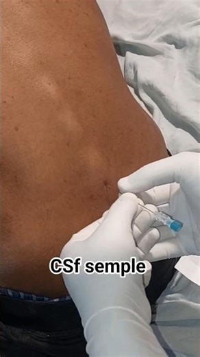 CSF Sample Collection and Culture Test | Full Procedure in Hospital #shorts #viral #trending