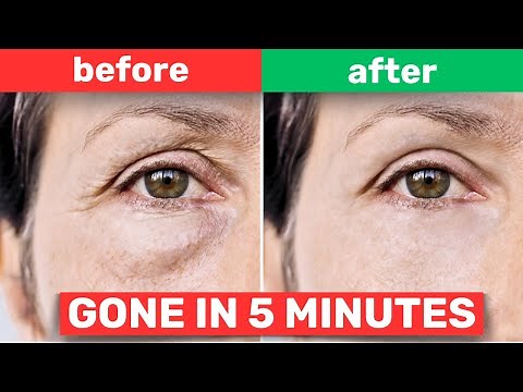 Get Rid of Puffy Eyes in 5 Minutes with This Simple Trick!