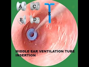 MIDDLE EAR VENTILATION TUBE INSERTION
