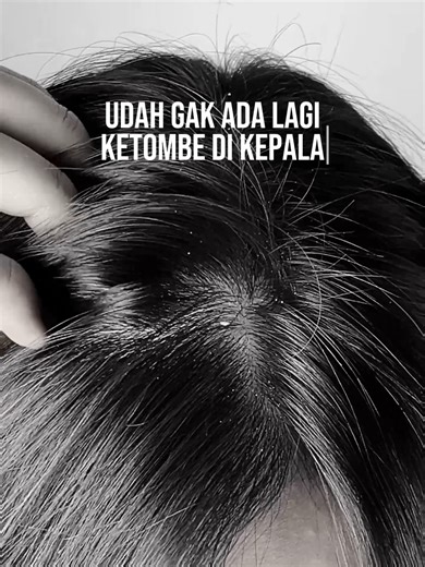Bye-bye rambut berketombe, karena rutin pakai shampo anti ketombe dari Pantene! #RambutPantene #FeelTheMiracle