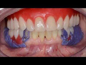 PPR: Moldagem funcional