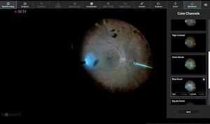 Vitrectomy for floaters with enhanced vitreous 2D (Narrated Case) - Eyetube