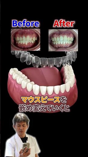マウスピースの矯正について解説します！#マウスピース#歯医者#鳥栖#小郡#みらい歯科・こども矯正歯科