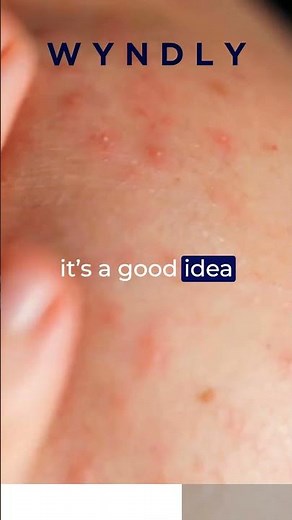 How Do You Treat An Adhesive Allergy?