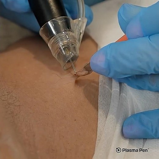 PlasmaPen Skin Tag Removal