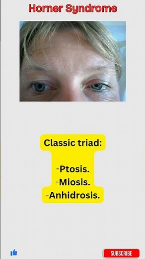 One Pupil Smaller? Horner Syndrome Made Simple | Sympathetic Lesion #shorts