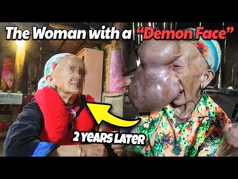 Mystery of The Woman with a “Demon Face” who had 4kg of “Demon Flesh” Surgically Removed by Doctors