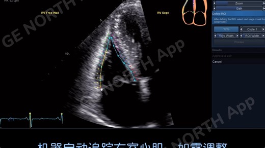 GE Vivid定量分析——AFI RV右室自动功能成像操作视频