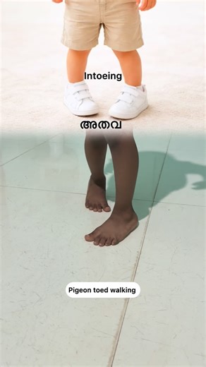 sensory physio on Instagram: "കുട്ടി നടക്കുമ്പോൾ കാൽ അകത്തോട്ടു തിരിയുന്നുണ്ടോ? ഇത് Intoeing / Pigeon-toed walking ആയിരിക്കാം. പല കുട്ടികളിലും സാധാരണമായി കാണുന്ന ഒന്നാണ്. സമയത്ത് ശ്രദ്ധിച്ചാൽ മതി Intoeing സാധാരണയായി ✔️ bones growth ✔️ muscle balance ഇവയുമായി ബന്ധപ്പെട്ടതാണ്. Right guidance = better outcome പല കുട്ടികളിലും കാണുന്ന സാധാരണ കാര്യം. വളരുന്നതിനൊപ്പം പലപ്പോഴും സ്വയം ശരിയാകും. എപ്പോൾ therapy വേണമെന്ന് അറിയണം #Instafit #daily #malayalam #parenting #physiotherapy"