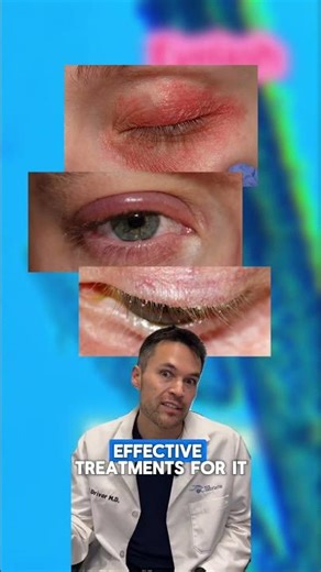 Eyelid mites AKA Demodex mites