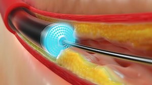 Excimer Laser Coronary Atherectomy (ELCA)