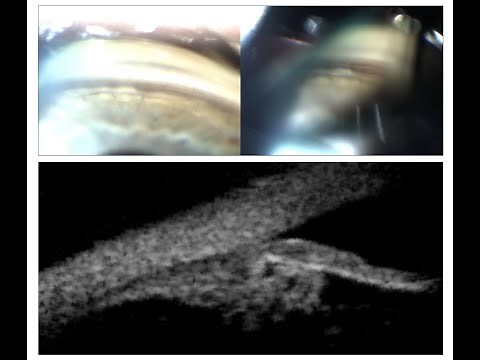 1 Slide in 5 Minutes: Plateau Iris Syndrome (Malik Y. Kahook, MD)