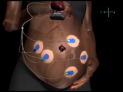 How Monica AN24 Fetal Monitor Works