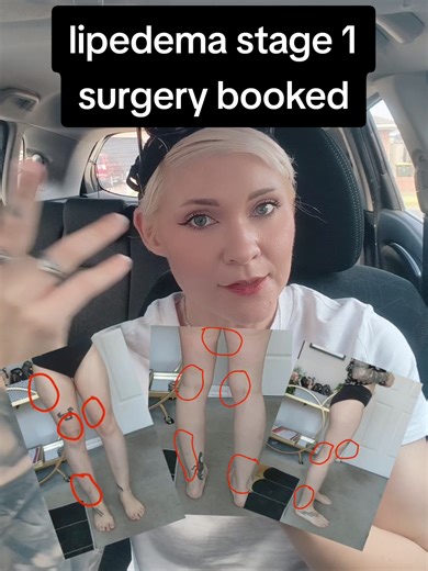 This is a video I went back and forth on making, but it felt important to be honest about it. I’ve decided to move forward with lipedema removal surgery, and I want to talk about why. Lipedema is actually quite common (especially in women) and it’s not something that can be fixed with diet, exercise, or willpower. For a long time I thought my body was just something I wasn’t trying hard enough to “fix,” when in reality it was a medical condition that isn’t widely understood or talked about. Shar