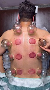 8.9M views · 44K reactions | Fire Cupping is an ancient technique...