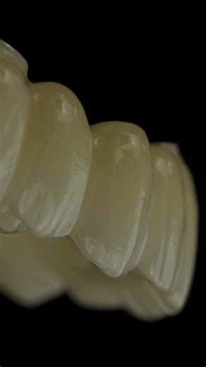 One of the world's most popular full-arch indications, available now with Nexus iOS. This is a full contour zirconia prosthesis, designed and milled directly to the multi-unit abutment. Ideal for FP1 style restorations, this design is exceptional for aesthetic cases where bar visibility is a concern. We utilize a specific cutback design to perfectly balance high-end aesthetics with structural strength. Ordered seamlessly via the Nexus Portal, including a 3D printed Try-In. #nexusios #osteonmedic