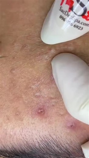 Crazy Satisfying Blackheads whiteheads Removing pimple popping 💫 #acne #blackhead #Treatments #pimple #satisfying How to remove blackheads and Whiteheads from nose and face naturally at home,how to remove blackheads in 5 minutes,how to remove blackheads at home instantly,how to remove blackheads from nose permanently,blackheads removal mask,clay mask for blackheads,how to remove blackheads with toothpaste,how to remove blackheads with vasline,how to remove deep blackheads at home,how to remove 