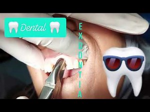 Atraumatic Approach For Extraction Of Upper Central Incisor