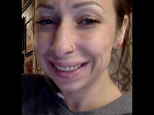 Day 1, after Extractions and Immediate Dentures