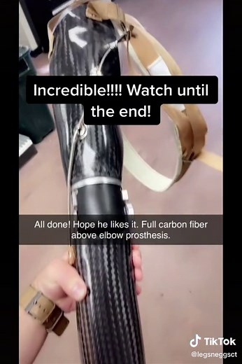 Incredible Body-Powered Upper Extremity Prosthesis