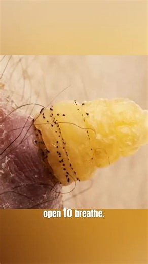 What is a Botfly (Dermatobia Hominis Lifecycle)