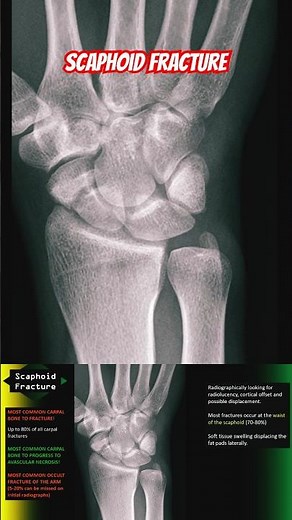 Scaphoid Fracture on X-Ray