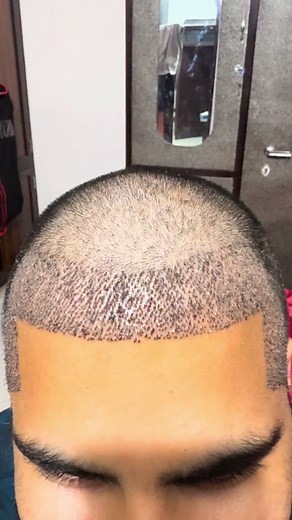 How to Remove Scabs on 10th day After Hair Transplant