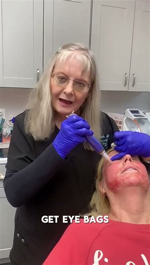 PRP Microneedling for Under-Eye Rejuvenation | K2 Restorative Medicine