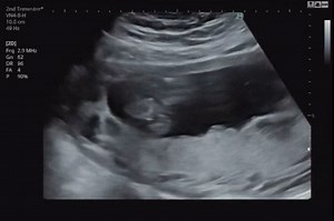 先輩ママさん教えてください！ 助産師さんには「3本線見えるから女の子だと思うけど、次もっとお股開いてる時に確定にしましょう」と言われました！ 女の子、男の子どちらに見えますか？ #妊婦健診 #性別 #性別判定 #ジェンダーリビールケーキ #マタニティ