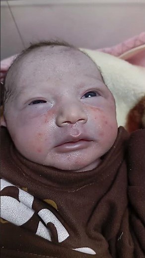 birth injury markes