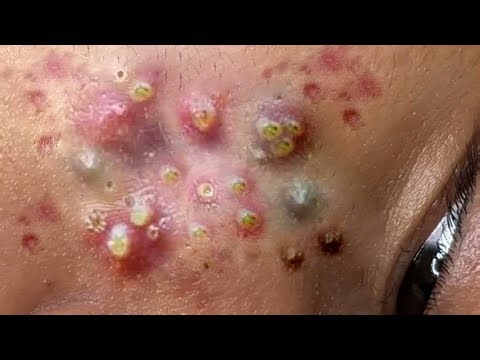 So Big Cystic Acne Blackheads Extraction Blackhead, Whiteheads Removal pimple popping 2025, 4k