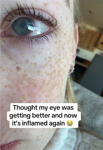 Battling Acanthamoeba Symptoms Again