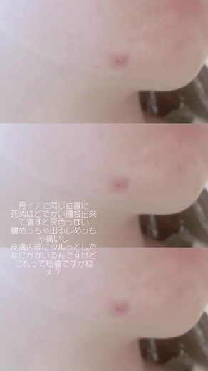 まじで痛いし紫色になるんですけども#肌改善 #肌荒れ #ニキビ #しこりニキビ #粉瘤 ？