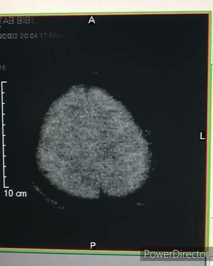 DWI on open MRI system|| stroke protocol