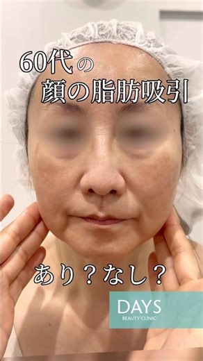 【小顔整形】脂肪吸引に年齢制限はある！？#shorts