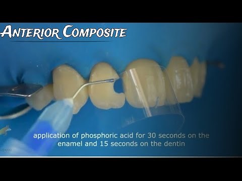 Class III Composite restoration Full case protocol from A to Z