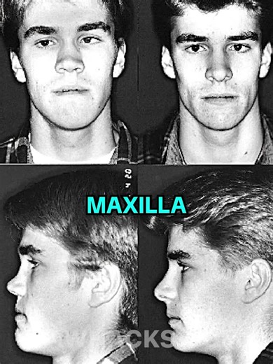 Ronald Ead on Instagram: "Your Face Is NOT Just Genetics🧬❌ The maxilla doesn't develop from genetics alone. Environmental factors like tongue posture, breathing patterns, breastfeeding, head posture, apply constant pressure to growing bones, literally reshaping facial structure during development. Twin studies show that even identical twins can have differences in maxillary development (https://pubmed.ncbi.nlm.nih.gov/9200255/). This demonstrates environmental factors at work. The mechanism is 